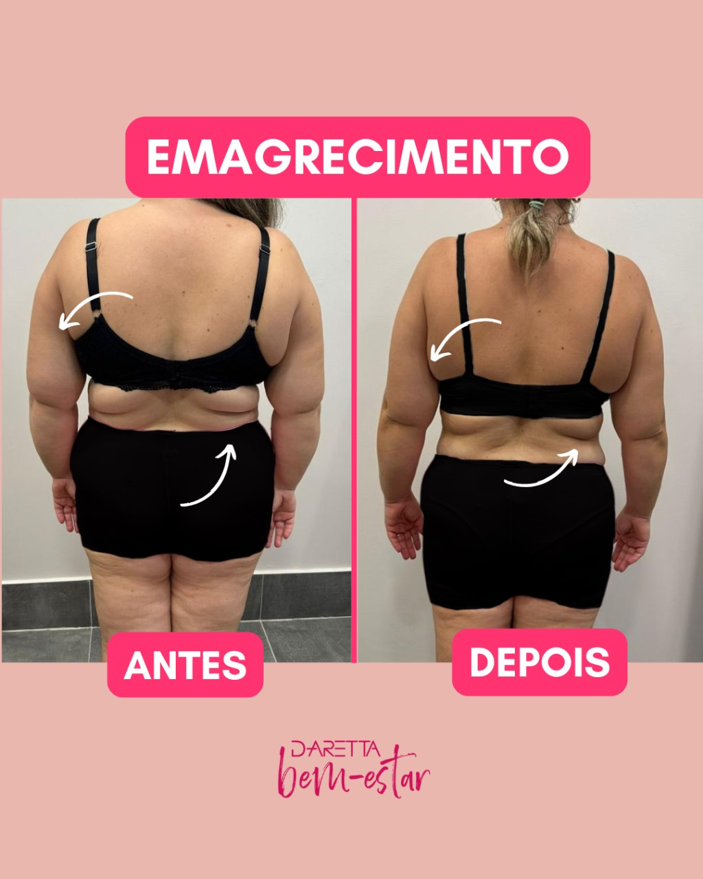 Antes e depois de emagrecimento