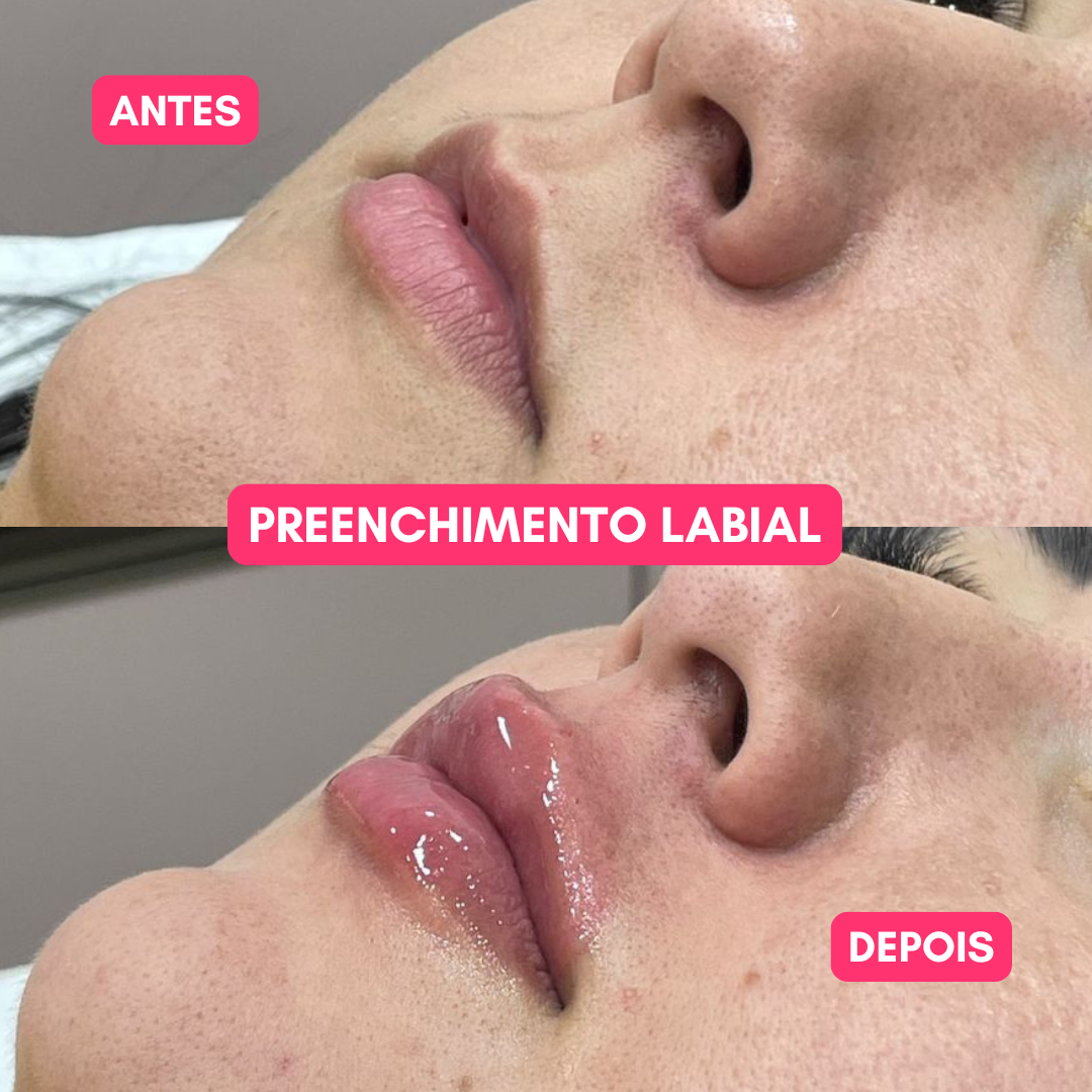 Preenchimento labial