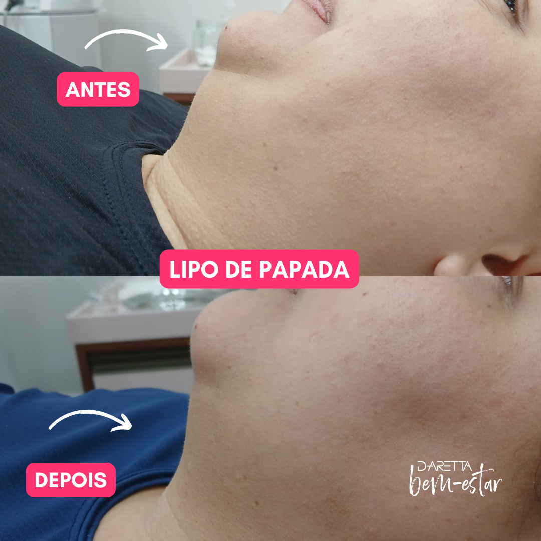 Lipo de papada