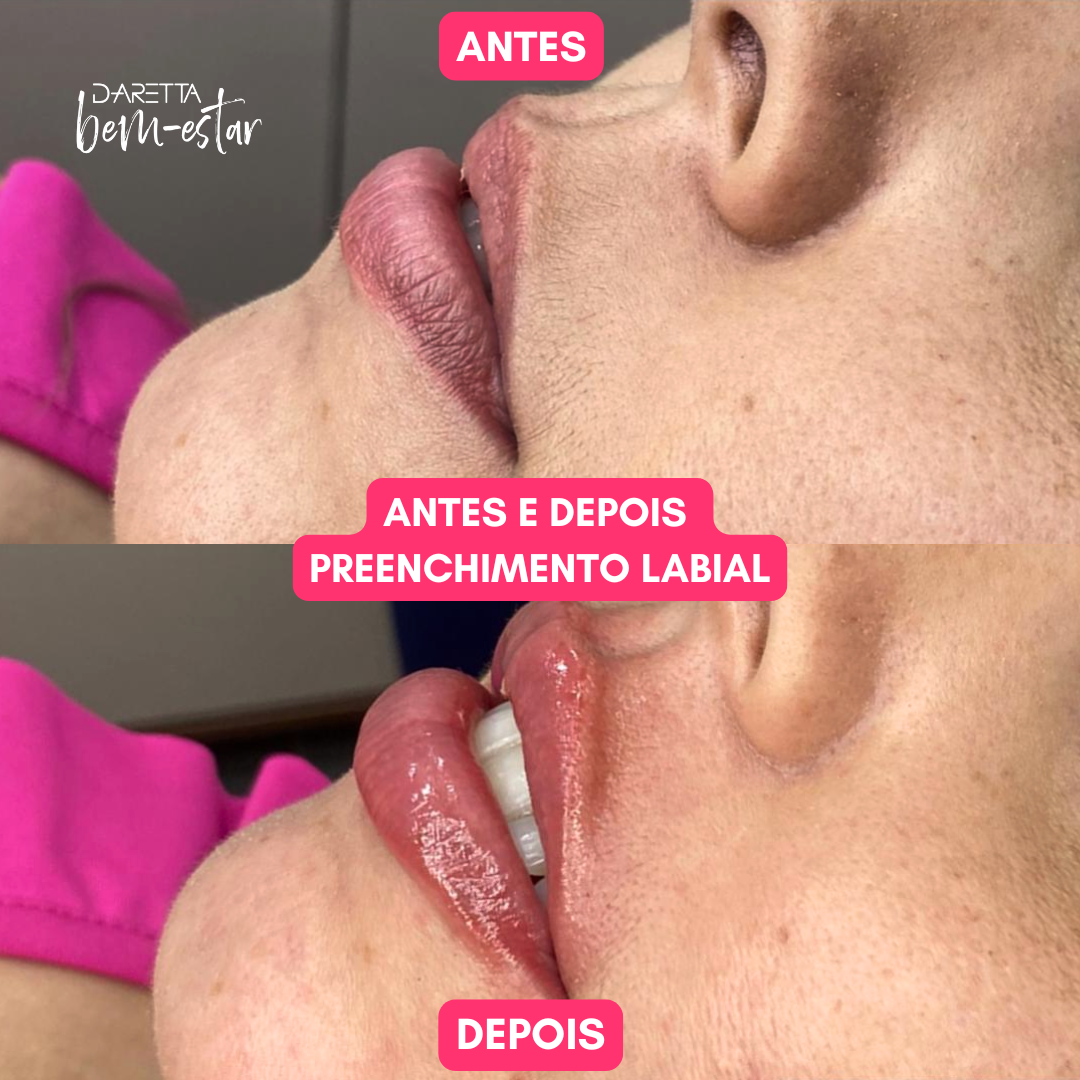 Preenchimento labial premium