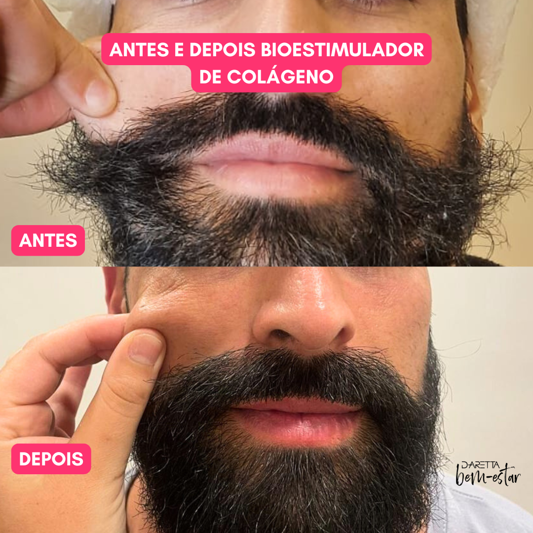 Bioestimulador de colágeno